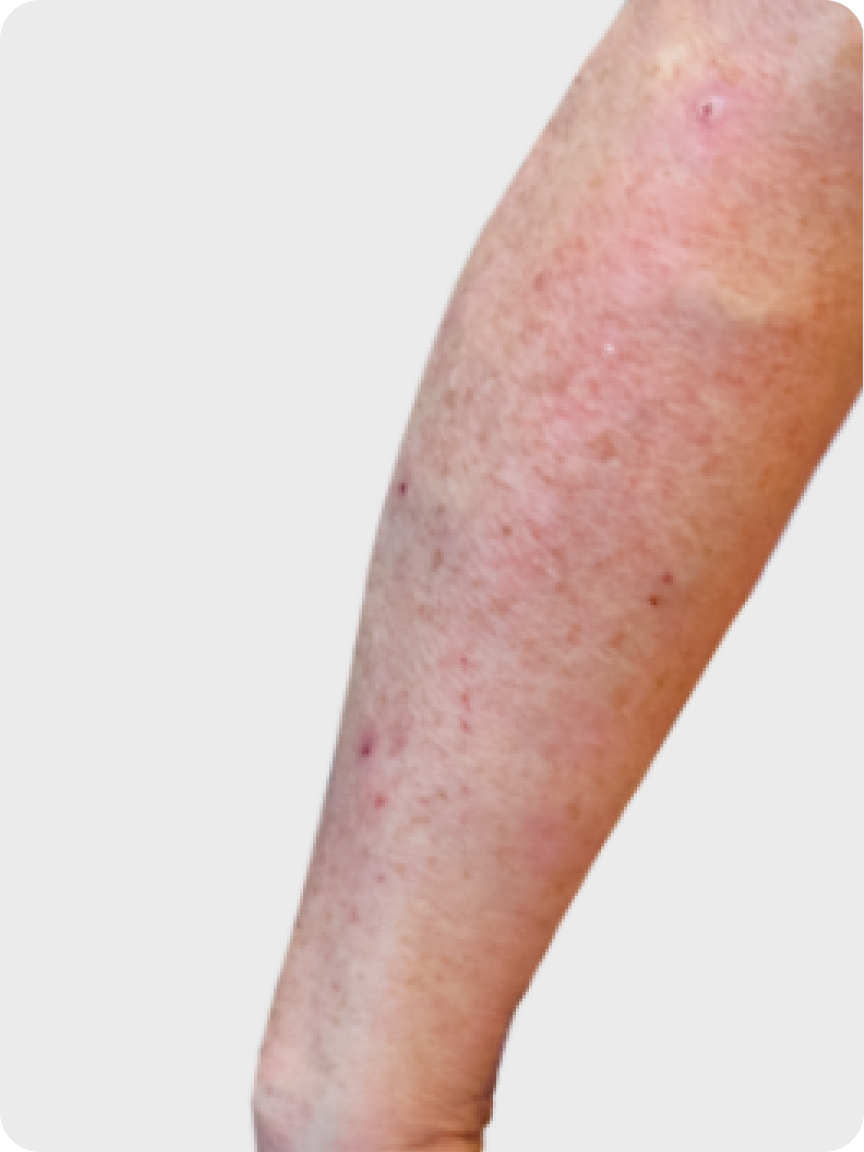 Prurigo nodularis on a patient's arm