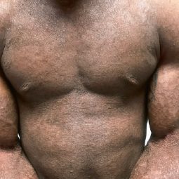 Moderate-to-Severe eczema on dark, brown, black skin on torso