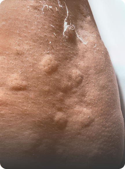 An Image of chronic spontaneous urticaria on brown skin