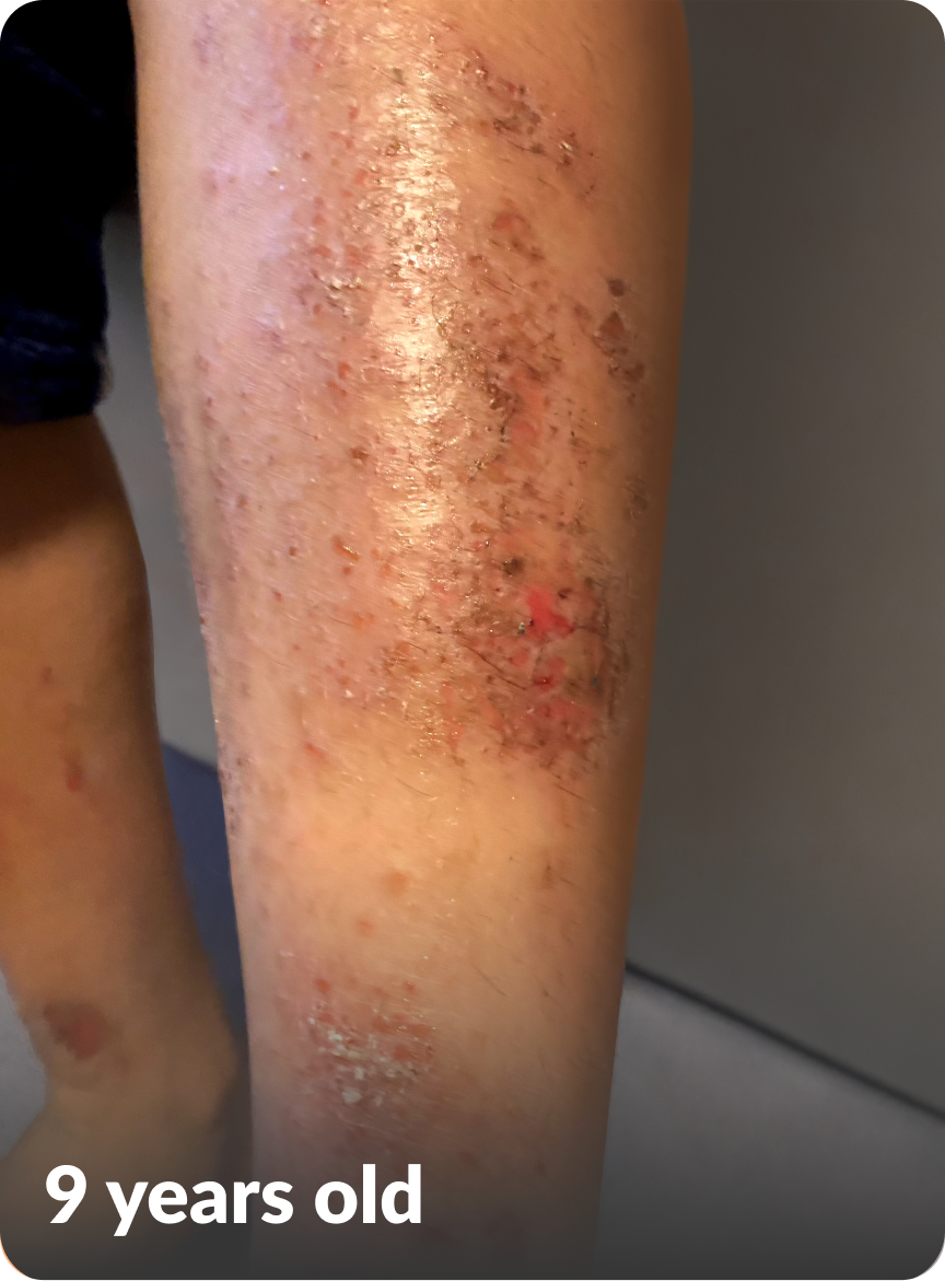 Kayden's moderate-to-severe atopic dermatitis on leg at nine years old