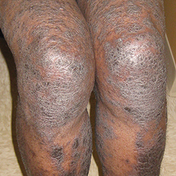 Moderate-to-Severe eczema on dark, brown, black skin on legs