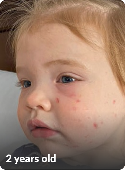 Lila's moderate-to-severe atopic dermatitis on face at two years old