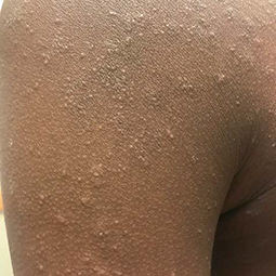 Moderate-to-Severe eczema on dark, brown, black skin on arm