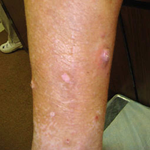 Prurigo nodularis (PN) on a patient's leg who is not on DUPIXENT® (dupilumab)